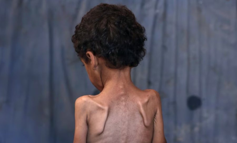 Save the Children: Fëmijët e uritur në Gaza nuk kanë forcë as të qajnë