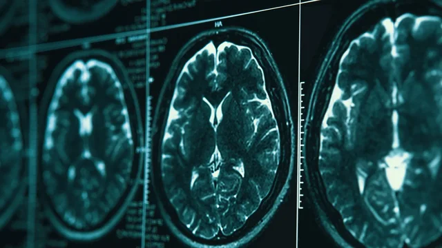 Shkencëtarët më pranë se kurrë zbulimit të kurës për Alzheimerin