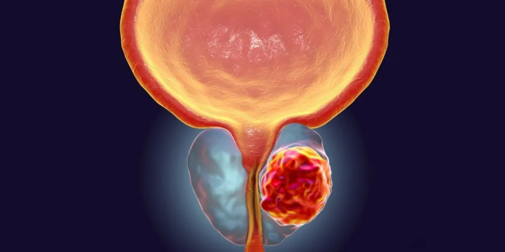 Lajm i mirë për njerëzimin! Shkenca ndihmon për kancerin e prostatës