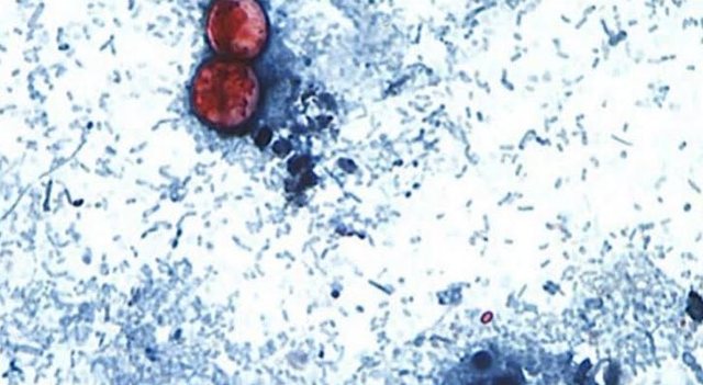 Mbi 3 mijë të prekur/ Përhapet infeksioni parazitar misterioz në SHBA