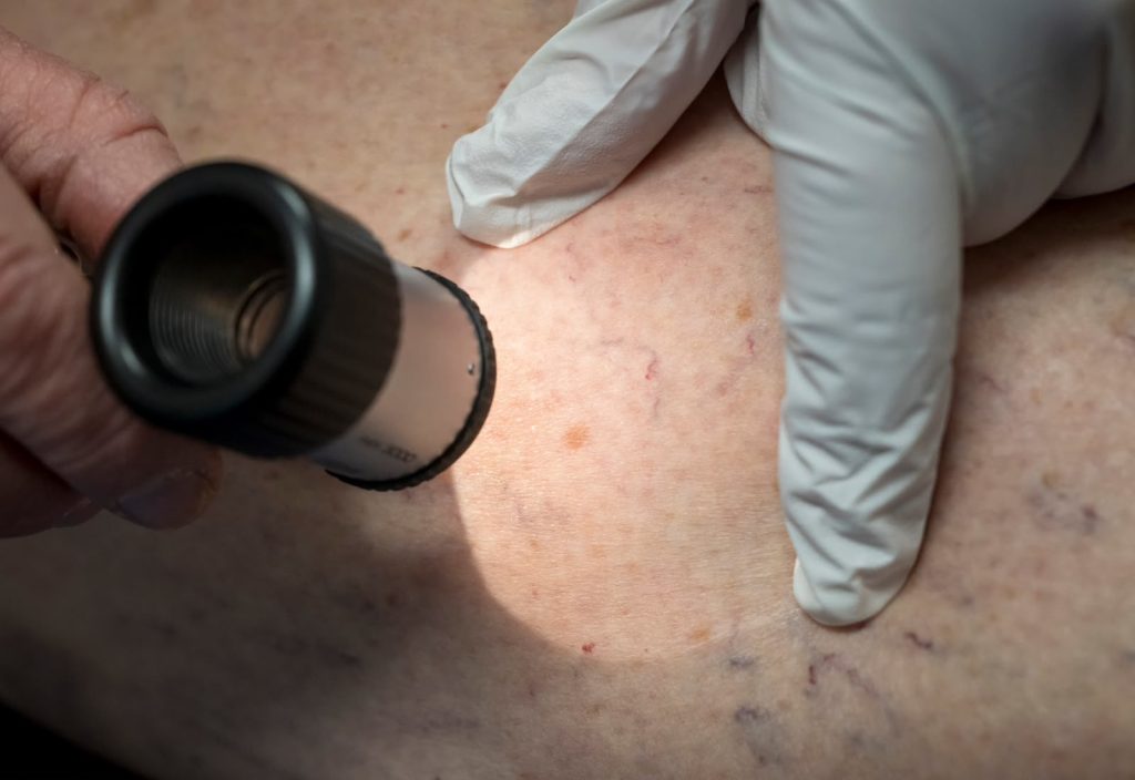 Shpresë e re kundër melanomës: Italia gati të testojë vaksinën terapeutike te pacientëtv