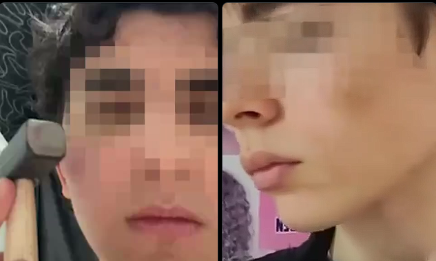 Trendi i frikshëm që po përhapet në Rusi/ Të rinjtë godasin fytyrën me çekiç për t’u dukur më të bukur, mbi 100 të plagosur